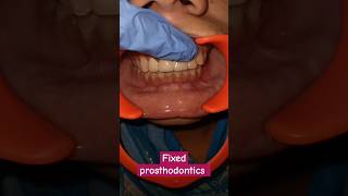 Fixed prosthodontics dentalcafe4331 [upl. by Artened]