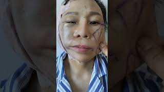 一邊做了，一邊沒做，對比明顯嗎？ medical plasticandbeauty plastic beautiful trending viralvideo fyp explore [upl. by Odilia]