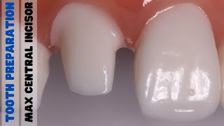 Tooth Preparation 🔵 Maxillary Central Incisor 🟡 PFM [upl. by Bogie]