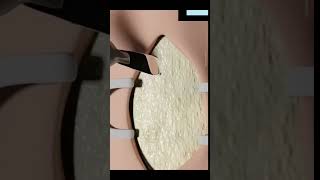 Tracheostomy procedure explained facts 3danimationfact funfacts [upl. by Mungam]