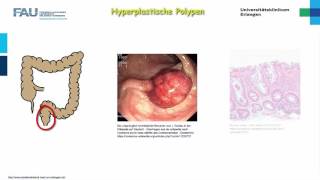 Pathologie ─ Darmerkrankungen [upl. by Charmian]