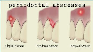 periodontal abcsess 2 peridontic abscess gingiva [upl. by Mosira]