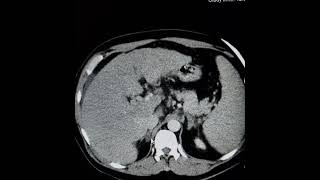 HCC with tumor thrombus extending into LHVIVCLT atrium intrahepatic branches of PV and PV itself [upl. by Artemis190]