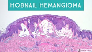 Hobnail Hemangioma Targetoid Hemosiderotic Hemangioma Retiform Hemangioendothelioma and Mimics [upl. by Brigitta]