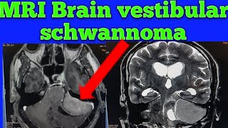 Mri Brain vestibular schwannoma case Mri Brain Acoustic Neuroma Mri Brain CP angle Tumor Tumor [upl. by Yerffoeg378]