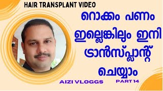 HAIR TRANSPLANT VIDEO HNS  മുഴുവൻ പണം ഇല്ലെങ്കിലും ഇനി ട്രാൻസ്‌പ്ലാന്റ് ചെയ്യാം [upl. by Troyes]