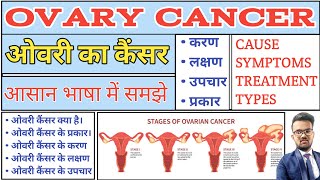 Ovary Cancer  Ovary Cancer Notes  Ovary sist Cyst  Ovary Cancer Treatment  Ovary Cust Treatment [upl. by Seamus]