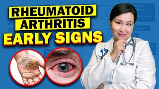 Early Warning Signs Of Rheumatoid Arthritis  Dont Ignore These Vital Symptoms [upl. by Rumit]