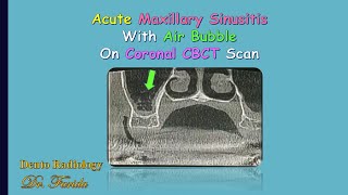 Acute maxillary sinusitisCBCT for nasal cavityAir fluid level and mucosal thickening [upl. by Constance153]