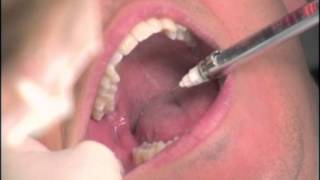 The Dental BoxInferior Alveolar Nerve Block [upl. by Jeanine]