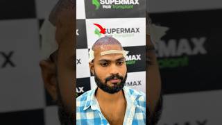 ₹1000 Downpayment hair transplant surgery haircare hairtransplant [upl. by Emmalynn]