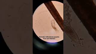 Microscopic examination of Demodex folliculorum in hair follicles [upl. by Oiramrej]