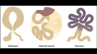 Closed loop obstruction with bowel ischemia  CT findings [upl. by Nevart]