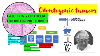 Calcifying epithelial odontogenic tumor CEOTDETAILEDPindborg tumor Tumors of odontogenic origin [upl. by Atnuahs]