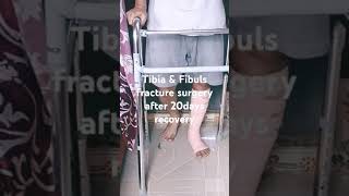 Tibia and Fibula fracture surgery after 20 days recovery Physiotherapy walking Exercise [upl. by Ennaehr]