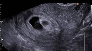 Chorionic bump 201117 [upl. by Asset753]