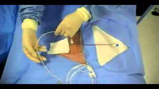 Insertion of Transvenous Pacemaker [upl. by Nolyar317]