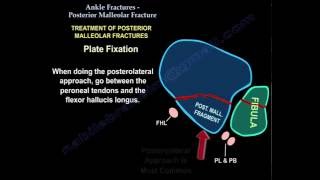 Ankle Fracturesand Posterior Malleolar Fracture  Everything You Need To Know  Dr Nabil Ebraheim [upl. by Mudenihc]