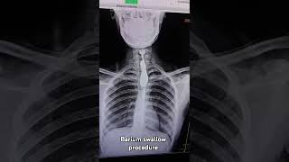 Barium swallow xray procedure xraybariumswallowradiographer medical [upl. by Bud231]