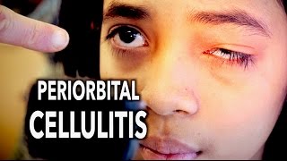 PERIORBITAL CELLULITIS Painful  Dr Paul [upl. by Culhert]