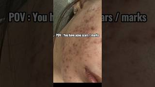 If you have acne marks then use thisskincareacnemarksshorts [upl. by Bevers]