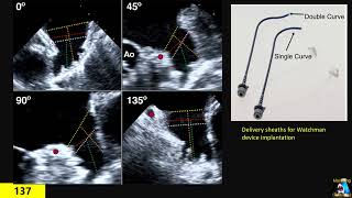 Left Atrial Appendage measurements amp Watchman [upl. by Ainelec]