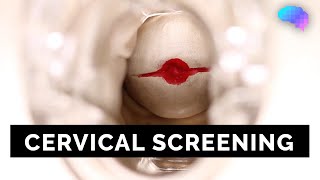 Cervical Screening SMEAR  OSCE Guide  UKMLA  CPSA [upl. by Airrotal515]