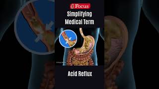 Acid reflux [upl. by Ssepmet]