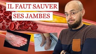 ARTÈRES des jambes BOUCHÉES et ULCÈRE de la PEAU ce quil faut savoir [upl. by Garek]