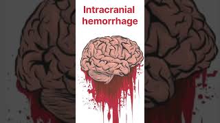 Control of Hyperpyrexia ice therapy during fever sponging during fever reason of hyperpyrexia [upl. by Ylremik]