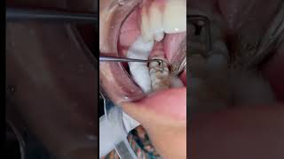 Teeth Filling Teeth cavity video [upl. by Brandie]