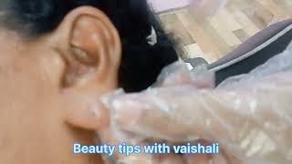 Earlobe treatment  earlobe repair without stitches [upl. by Acirretahs]