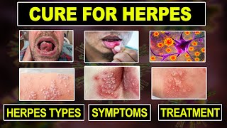 What is Herpes  Herpes Types Symptoms amp Treatment  Herpes Virus [upl. by Tracee]