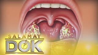 Salamat Dok Information about tonsil stones [upl. by Lehcsreh]