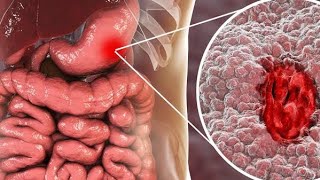 Carcinoma of the stomach [upl. by Leverett474]