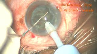 Phaco  Multifocal IOL 051024 [upl. by Arreik511]