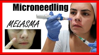 ¿Cómo ELIMINAR el MELASMA con MICRONEEDLING Dermapen en CASA Ácido TRANEXÁMICO [upl. by Twitt]