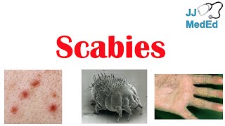 Scabies Skin Condition  What Is It Classic vs Crusted Types Signs amp Symptoms Treatment [upl. by Lewellen976]