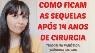 Como ficam as sequelas após 14 anos de cirurgia do tumor na parótida [upl. by Lrub225]