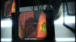 Ulcera Gastrica [upl. by Deland]