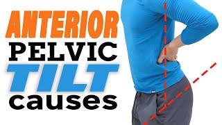 What Causes Anterior Pelvic Tilt Part 2 Weak Muscles In APT [upl. by Descombes442]