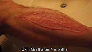 Part 4  Brads Surgery 4 months after graftb [upl. by Sillad150]