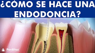 ¿Qué es una Endodoncia  Tratamiento de conductos o desvitalización del diente paso a paso © [upl. by Euqinamod]