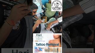 Small Tattoo Removal📍 Gooty 🏰 Kurnool road opposite captain high school ☎️7207778407 [upl. by Eniluj643]