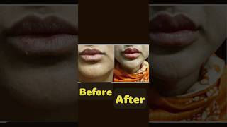 You MUST Watch  💋Lip Filler Injection for Fuller Plump Lips [upl. by Tj]