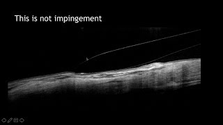 Anterior Segment amp Contact Lens Applications of OCT [upl. by Eseerahs]