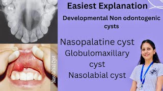 Developmental Non Odontogenic cysts Oral Pathology BDS Nasopalatine Globulomaxillary Nasolabial [upl. by Keily]