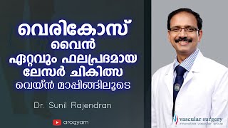 വെരികോസ് വെയ്ൻ ഏറ്റവും ഫലപ്രദമായ ചികിത്സ  Varicose veins Treatment in Malayalam Dr Sunil Rajendran [upl. by Madanhoj]