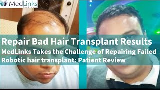 Repair Bad Hair Transplant in Delhi 2024 Best Hair Transplant in Delhi 2024  Medlinks [upl. by Anohs]