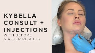 Kybella Consulation amp Treatment Everything You Need to Know [upl. by Thomey618]